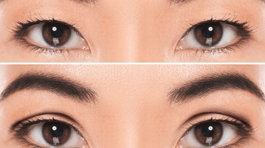 Before and After Double Eyelid Surgery - What to Expect