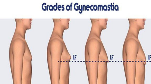 Understanding Gynecomastia Surgery Cost in Government Hospitals