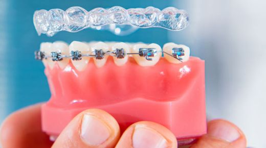 Invisalign clear aligners In Fontana