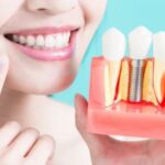 Dental Implants for People with Metal Allergies