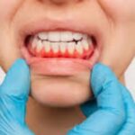 Dealing with gum disease: Learn more about symptoms, causes, and more. 