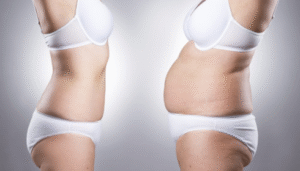 tummy tuck in Atlanta