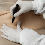 # A Complete Guide to Tummy Tuck Surgery in Bangalore: What You Should Know Before the Procedure