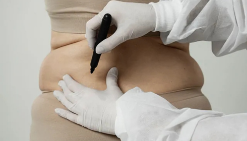 tummy tuck surgery in bangalore